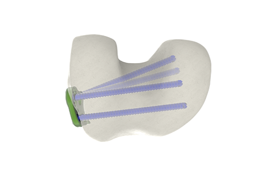 Derot option mediale dessous 1.1