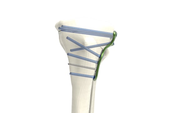Fermeture lateral coupe oblique avec vis VUE PROFILE