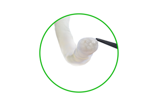 Avance nerve graft