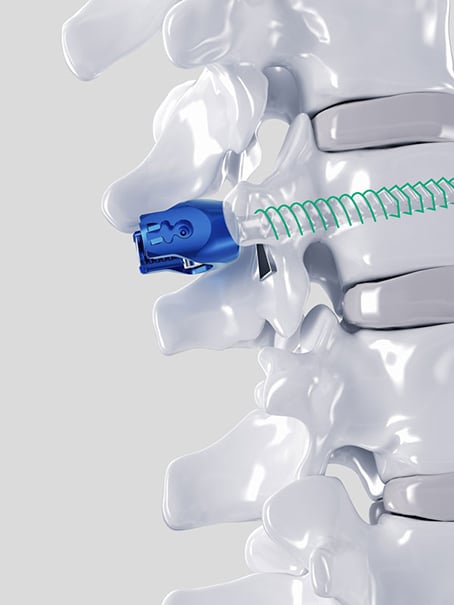 Ennovate® Thoracolumbar & Sacropelvic Screw