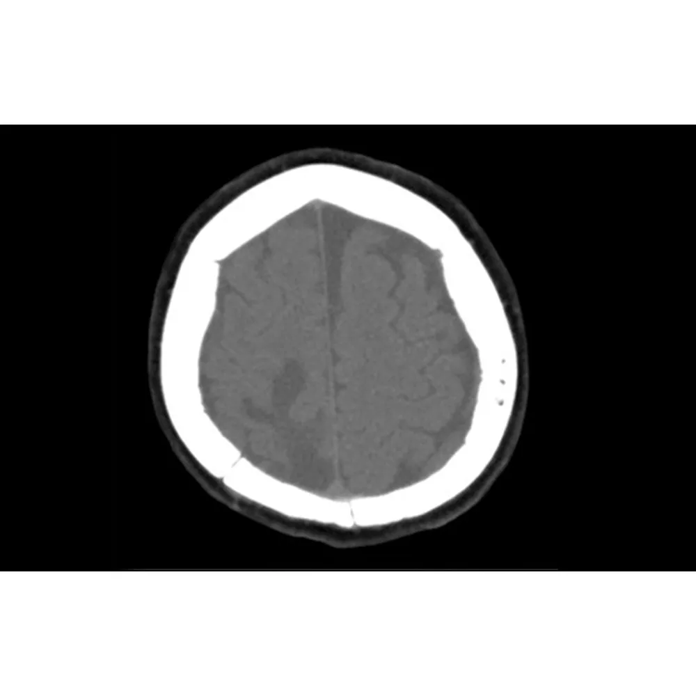 Cranial Loop Flap Fixation