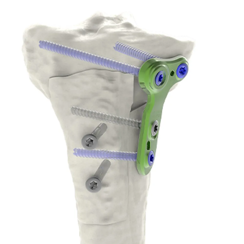 HTO Anterior Slope Change