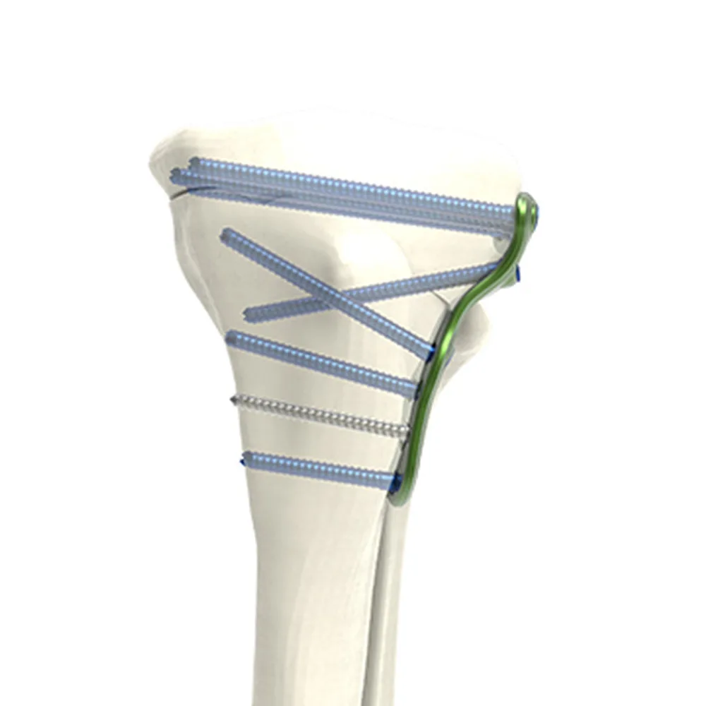 HTO closing lateral plate