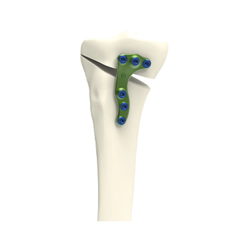 HTO opening medial plate